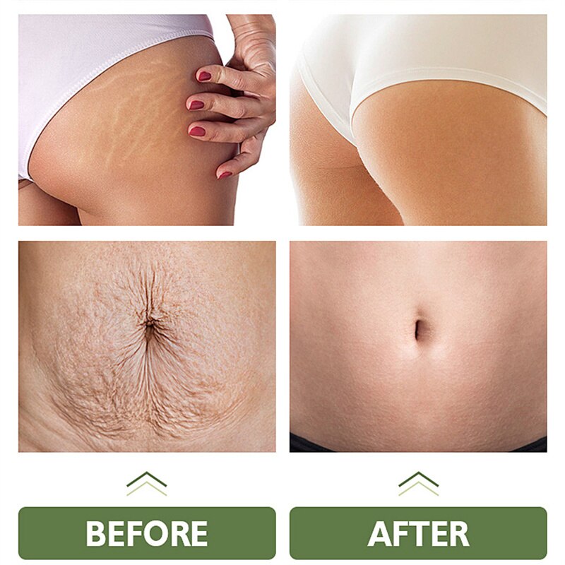 Stretch Marks Remover Cream